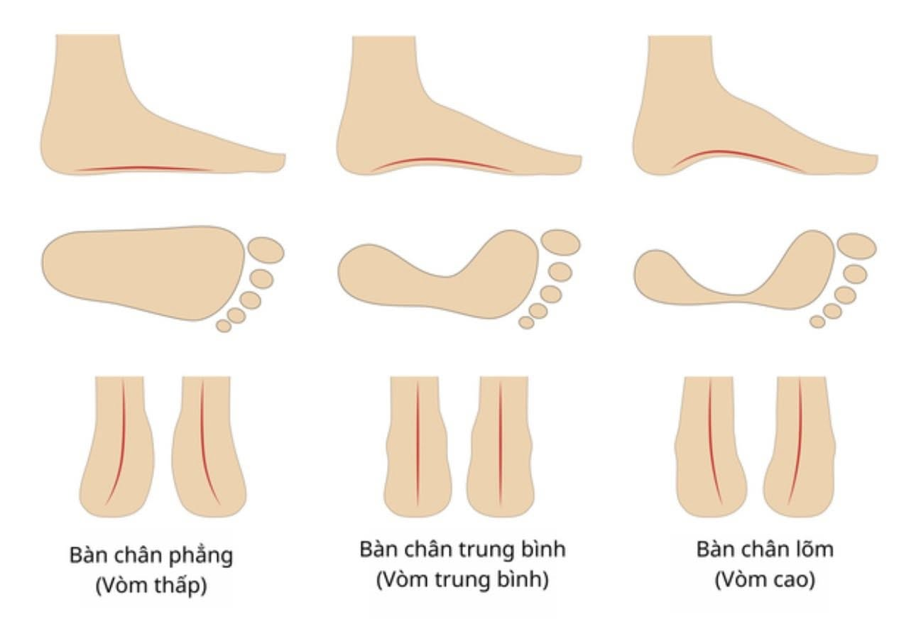 Foot arch types and leg alignment